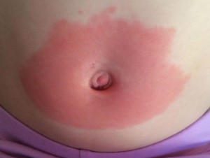 Borreliose utslett (Erytema migrans) på magen til et lite barn. Utslettet har en kraftig rød farge og en ujevn fasong. Foto: Flåttsenteret